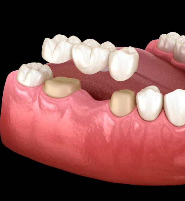 Dental Bridges