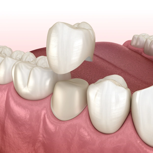 Dental Crowns