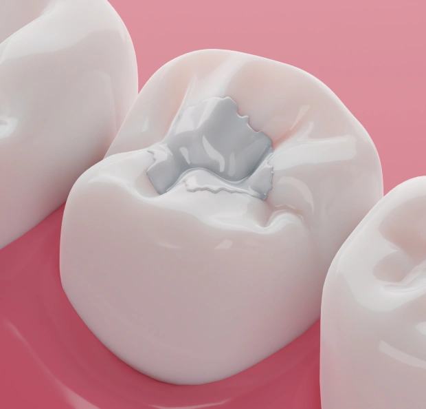 Dental Fillings