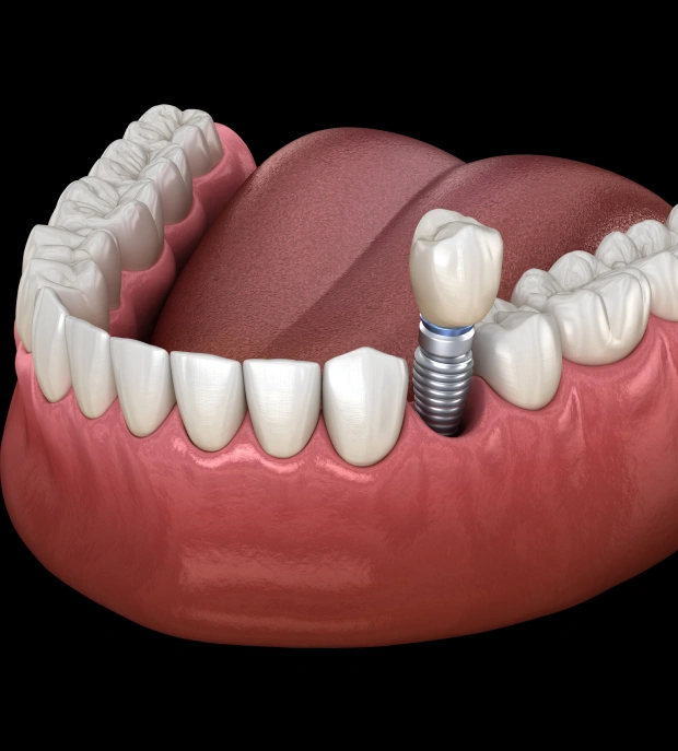 Dental Implants