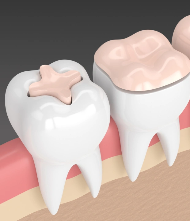 Porcelain Inlays & Onlays